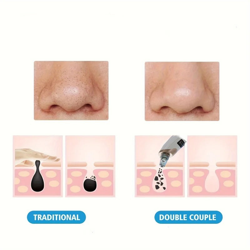 Blackhead Remover – Deep Pore Cleansing Vacuum Tool